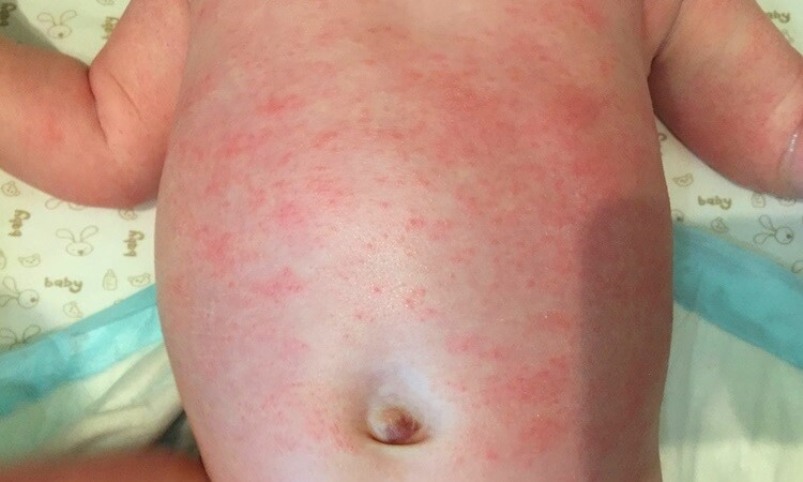 Allergiás urticaria a porhoz